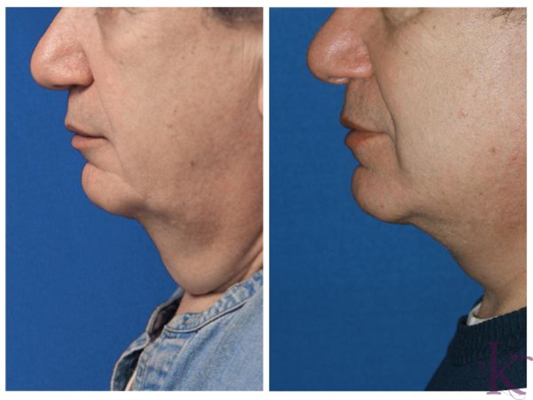 Before & After Male Face & Neck Lift Case 77 View #1 View in New York, NY