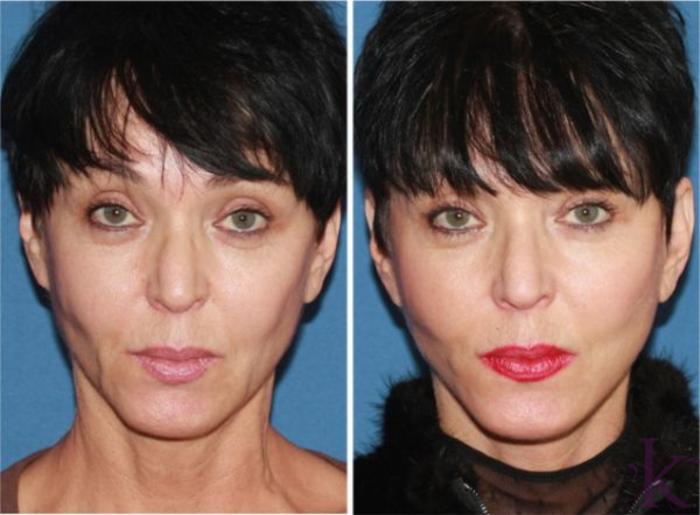 Facelift Case #29 Dr. Vasyukevich Facial Plastic Surgeon NYC