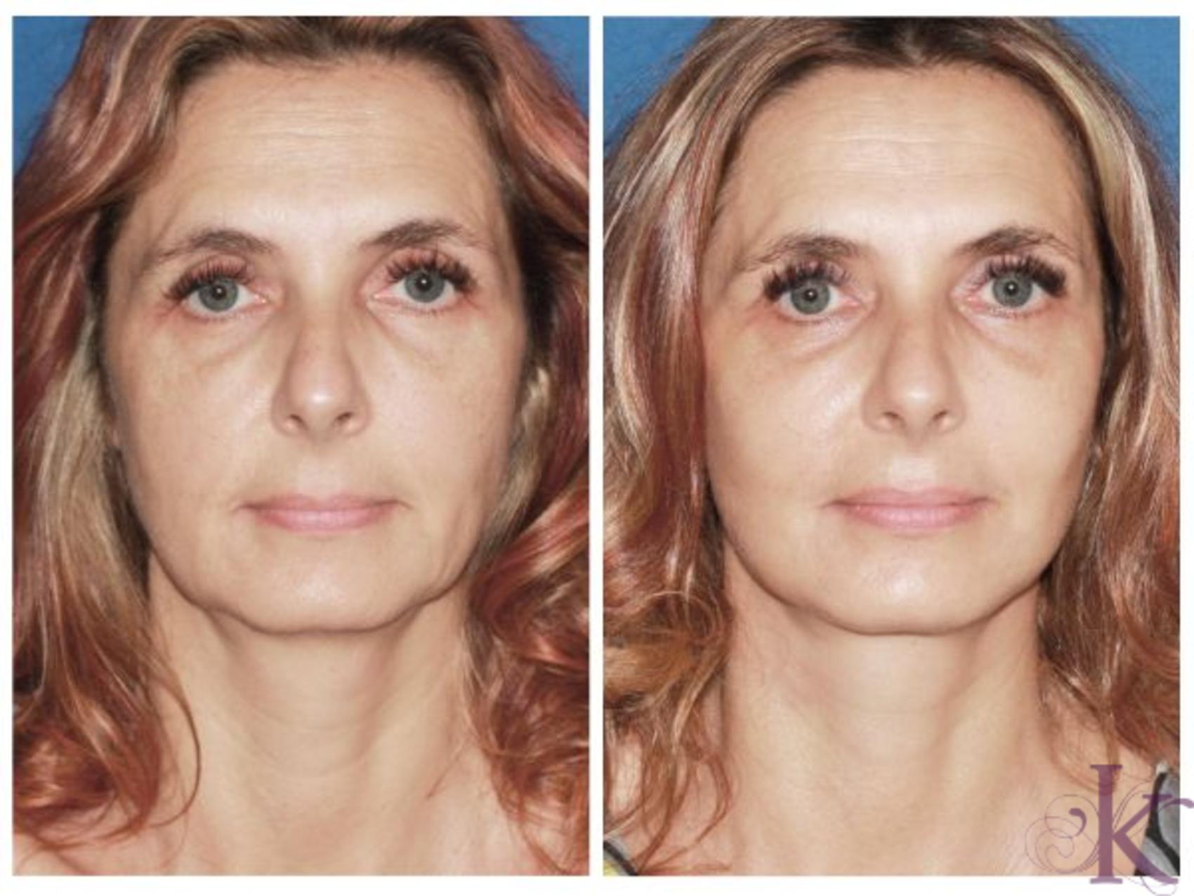 Mini Facelift Before And After Photo Gallery New York NY 