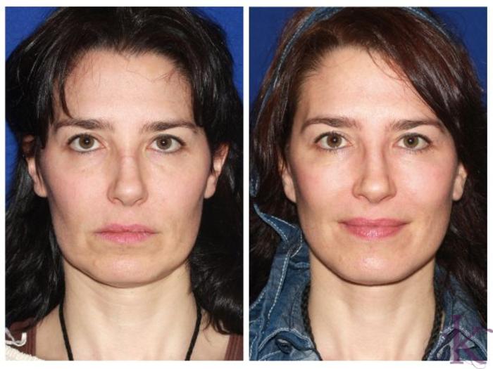 Mini Facelift Before and After Pictures Case 770