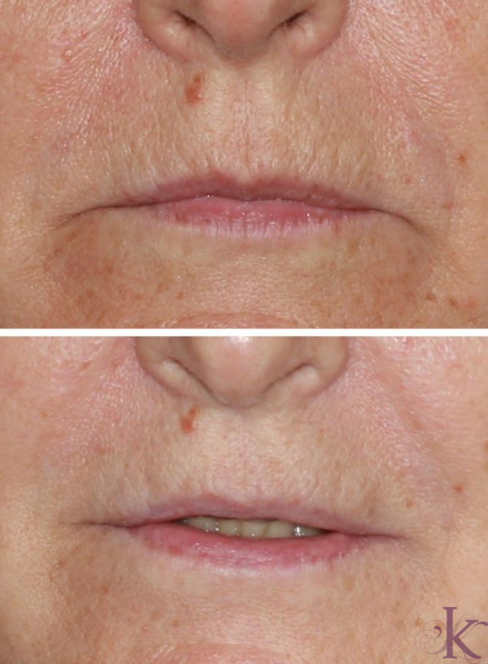 Before & After Skin Resurfacing Case 34 View #1 View in New York, NY
