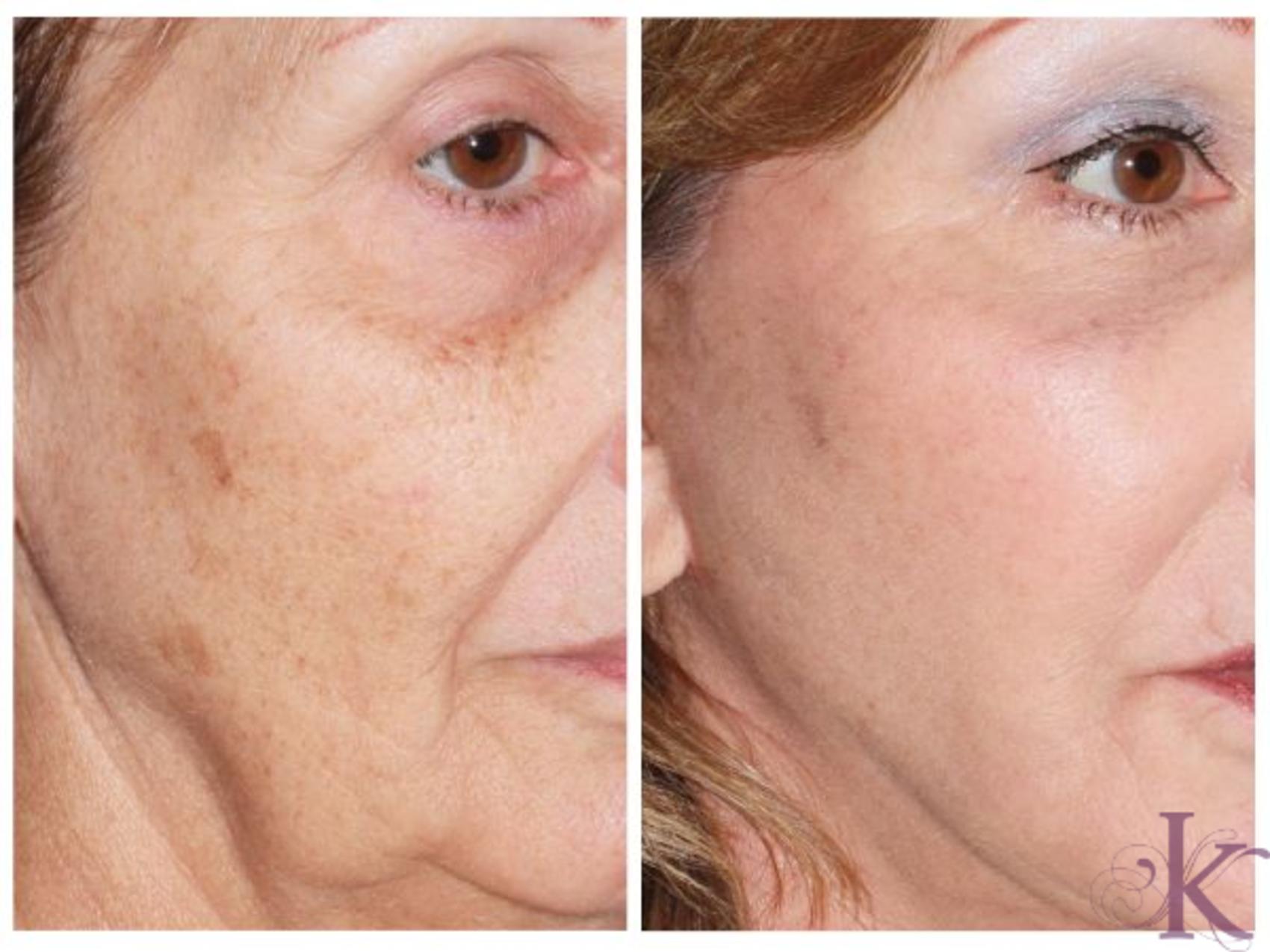 Before & After Skin Resurfacing Case 43 View #1 View in New York, NY